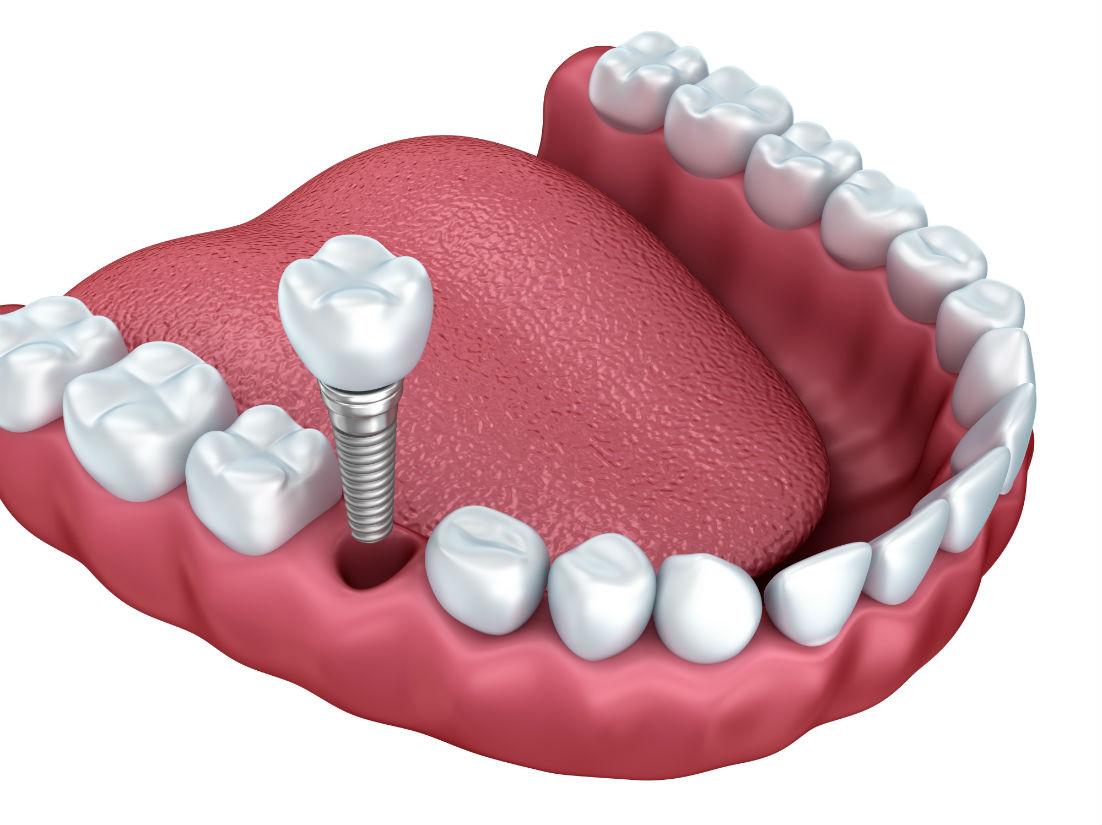 Dental Implants Fremont, CA