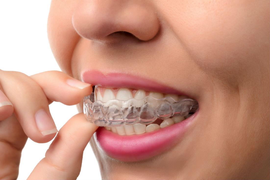 Invisalign® Expert Orthodontist in Dublin, Ireland