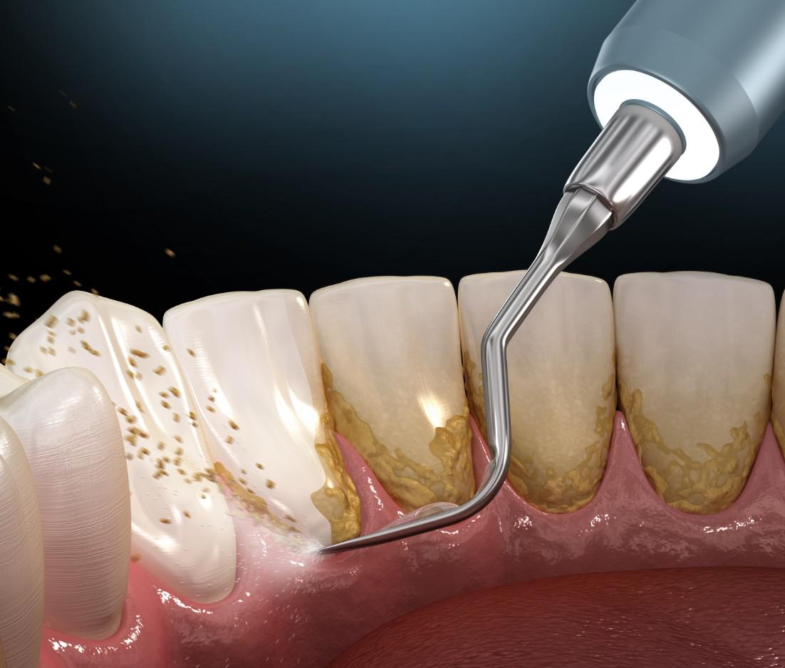 Dental Plaque: What You Need to Know
