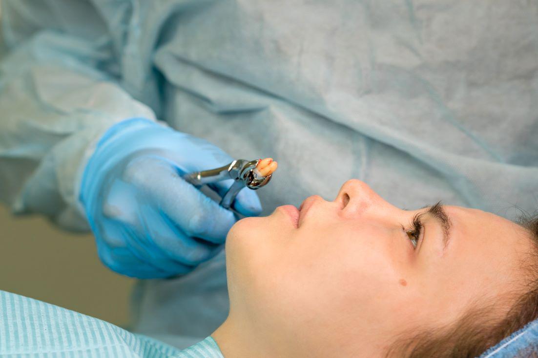 This Is How Wisdom Teeth Are Removed